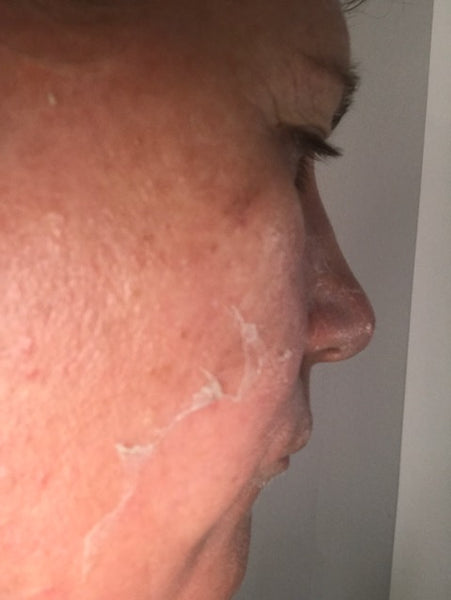 ARE RESURFACERS AND PEELS THE SAME?